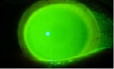 Mejora de la visión con lentes de contacto especiales para queratocono, lentes esclerales, lentes rígidas, lentes permeables al gas.