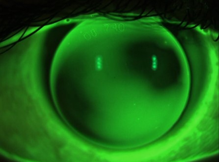 Contact lenses for Keratoconus in valencia